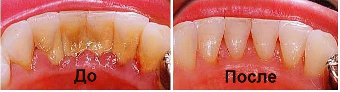 Комплесная чистака зубов до и после