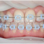 Выравнивание зубов современными методами
