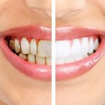 Что такое «зубной камень»?