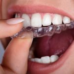 Рекомендации по выбору отбеливающих кап для зубов