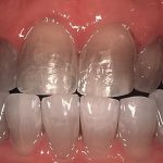Отбеливание зубов — причины потемнения эмали, противопоказания