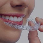 Отбеливание зубов — востребованные методы